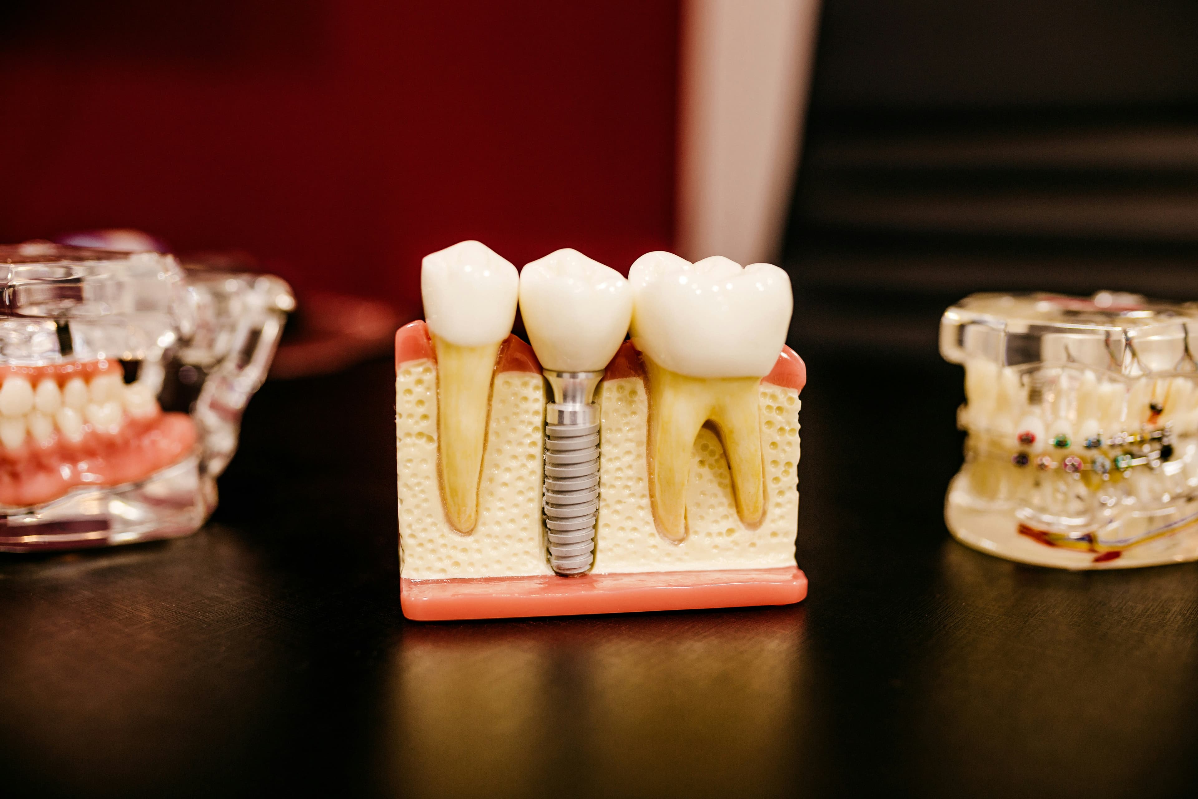 Missing tooth replacement options discussed at Grace Dental Care in Kathmandu