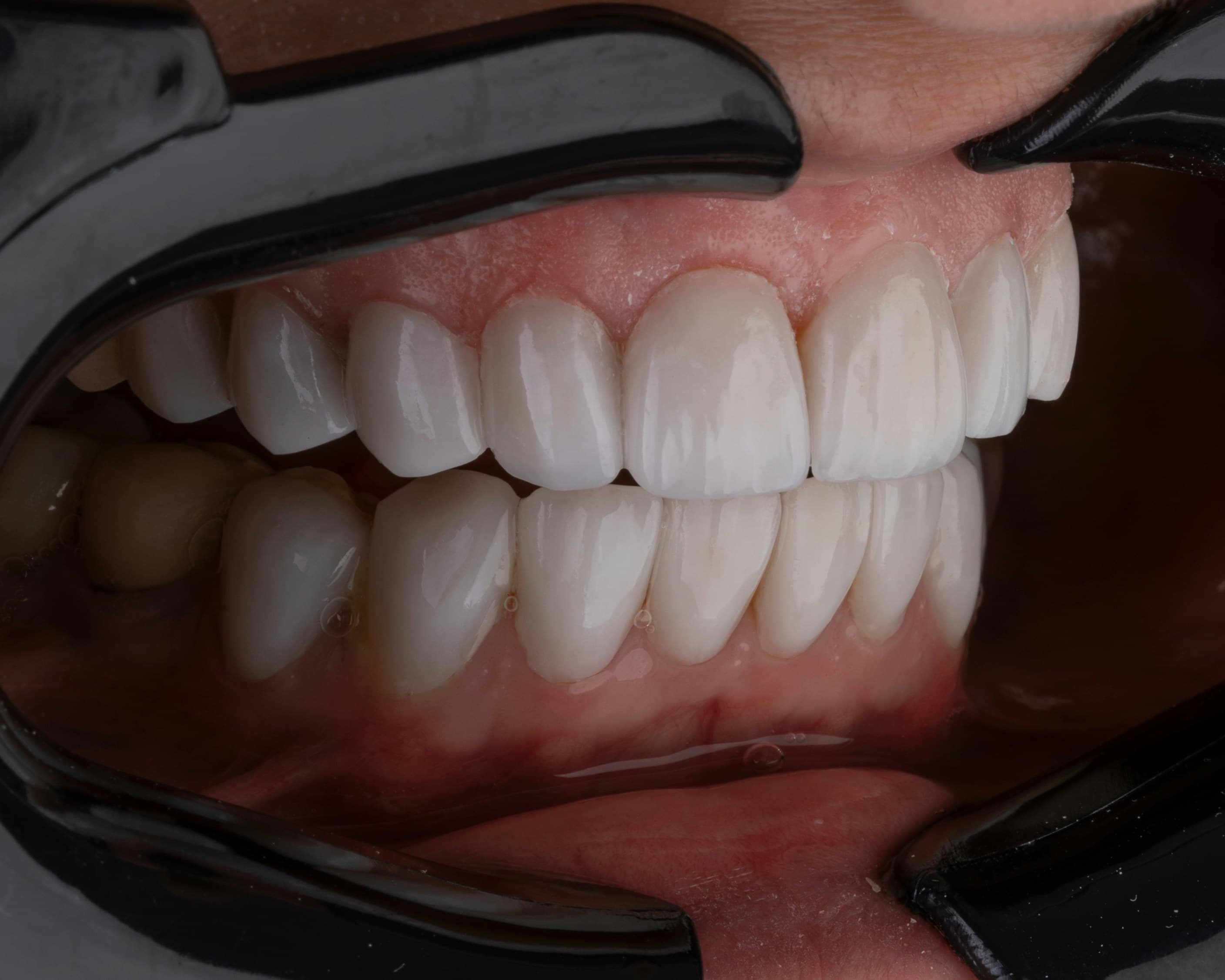 Professional teeth whitening guidance at Grace Dental Care in Kathmandu, Nepal